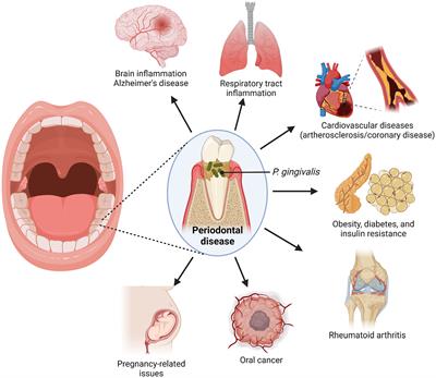 Implications of Porphyromonas gingivalis peptidyl arginine deiminase and gingipain R in human health and diseases